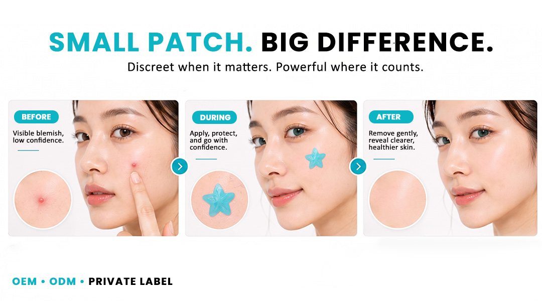 AllMask acne pimple patches in different shapes and designs for targeted blemish care